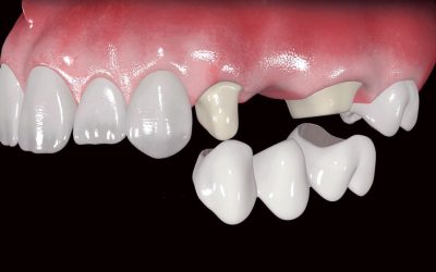 ¿Qué son las Prótesis Dentales?